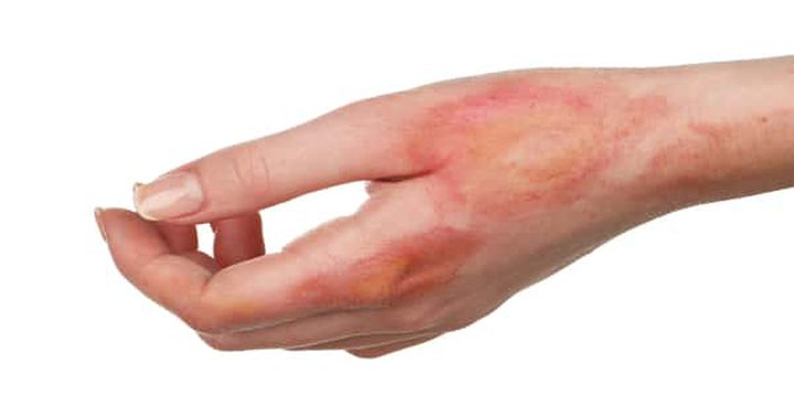 طرق ​​​​​​​​علاج الطفح الجلدي في المنزل