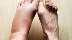 تقنية جديدة للتخلص من تجلطات الساق