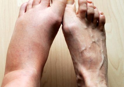 تقنية جديدة للتخلص من تجلطات الساق