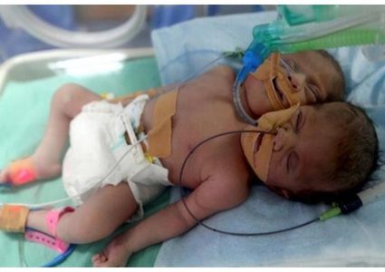 ولادة نادرة.. رضيع برأسين وقلب واحد في مصر
