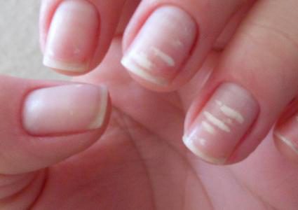 الغدة الدرقية والقلب..أمراض يمكنك اكتشافها ببقع بيضاء على الأظافر