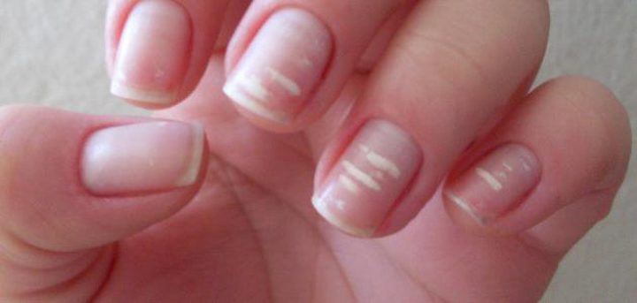 الغدة الدرقية والقلب..أمراض يمكنك اكتشافها ببقع بيضاء على الأظافر
