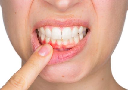 أبرز طرق علاج التهاب اللثة