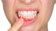 أبرز طرق علاج التهاب اللثة
