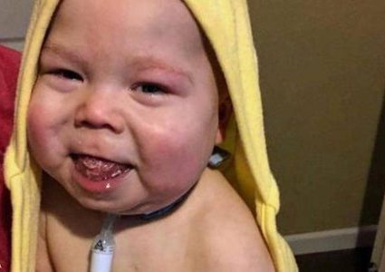 بهدف إنقاذه.. جراحة نادرة لـ"قطع لسان" رضيع