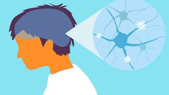 دراسة: مؤشر كتلة الجسم يلعب دورا مهما في تطور مرض التصلب المتعدد