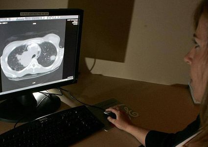 لماذا يصاب غير المدخنين بسرطان الرئة؟