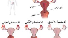 5 أمور يجب معرفتها قبل إجراء عملية استئصال الرحم