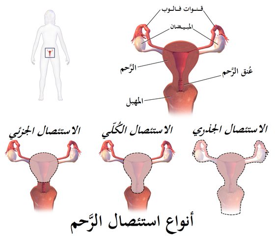 5 أمور يجب معرفتها قبل إجراء عملية استئصال الرحم