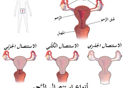 5 أمور يجب معرفتها قبل إجراء عملية استئصال الرحم