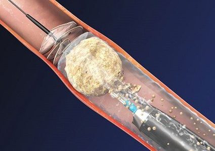 جهاز جديد لتفتيت حصى الكلى