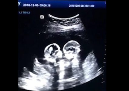 فيديو "صادم" لجولة ملاكمة بين توأمين في رحم أمهما