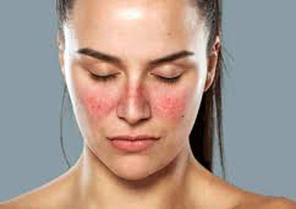 الذئبة المرض القاتل الصامت.. تعرف على أعراضه وعوامل الخطر