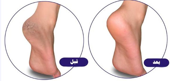 ارتدي أحذية الصيف دون قلق..وصفة طبيعية للتخلص من تشقق القدمين