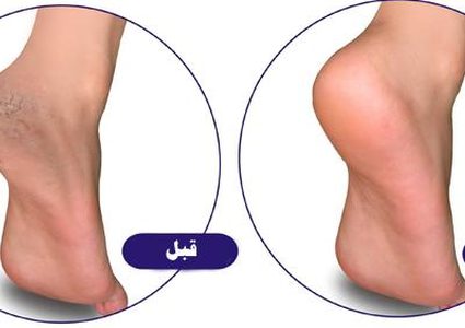 ارتدي أحذية الصيف دون قلق..وصفة طبيعية للتخلص من تشقق القدمين