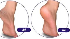 ارتدي أحذية الصيف دون قلق..وصفة طبيعية للتخلص من تشقق القدمين