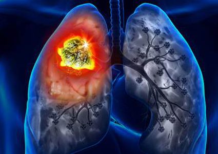 علامات الإصابة بسرطان الرئة لدى فئة "غير المدخنين"