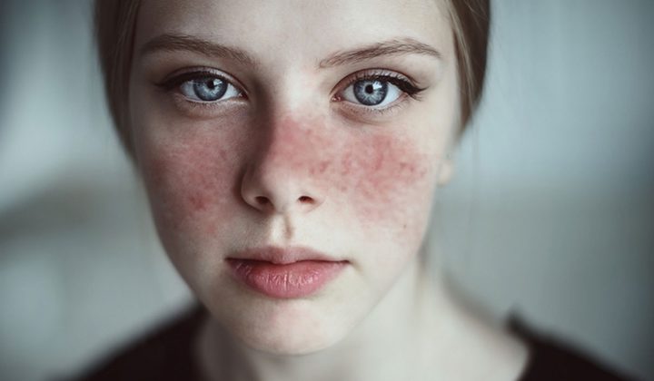 إنتاج أول عقار لعلاج الأطفال من "الذئبة الحمراء"