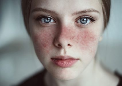 إنتاج أول عقار لعلاج الأطفال من "الذئبة الحمراء"