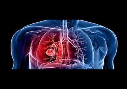 موزع سجائر يقيم دعوى ضد مشغليه بعد إصابته بسرطان الرئة