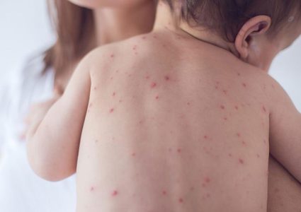 جامعة أمريكية تشدد على ضرورة تلقي البالغين لجرعة معززة ضد الحصبة