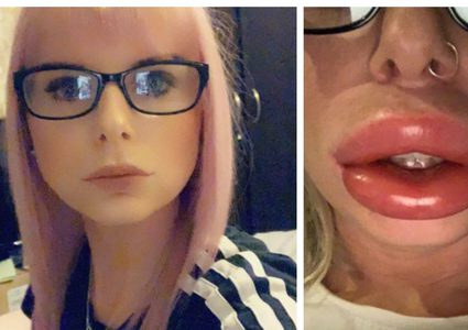 حقنة "فيلر" تحوّل سيدة بريطانية الى بطة بائسة