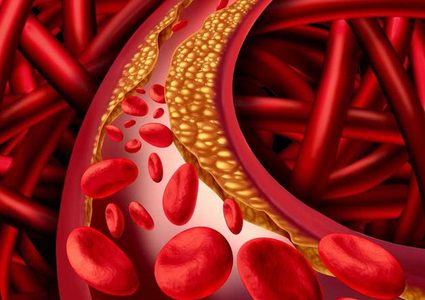 خلطة خارقة للتخلص من ارتفاع الضغط وانسداد الشرايين والكوليسترول