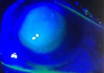 صور "مروعة" لامرأة نامت بعدساتها اللاصقة