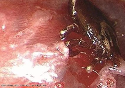 أطباء يتمكنون ينقذون طفل من هجوم القراد على طبلة أذنه