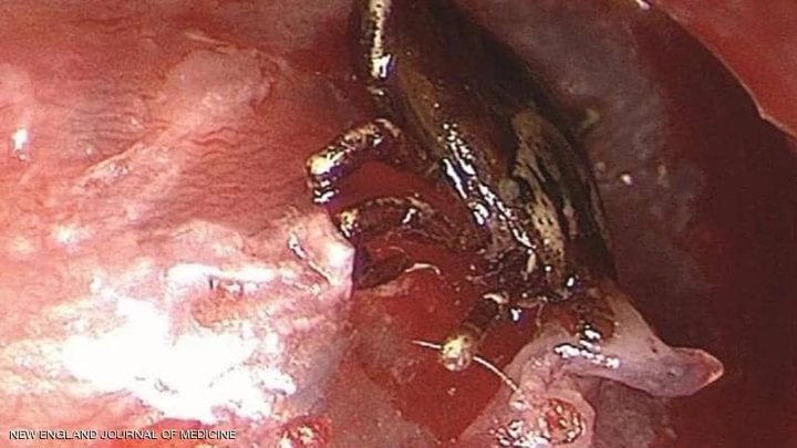 أطباء يتمكنون ينقذون طفل من هجوم القراد على طبلة أذنه