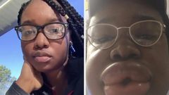 تناولت شطيرة "برغر" فانتفخ وجهها بشكلٍ مرعب