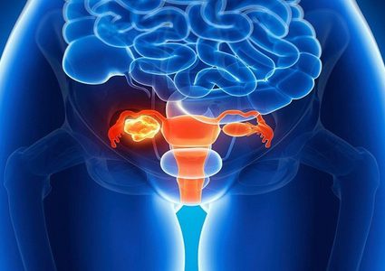 7 علامات مبكرة للإصابة بسرطان المبيض