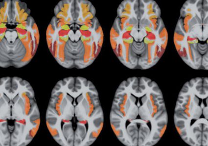 مرض شائع يصيب الدماغ شبيه بالزهايمر