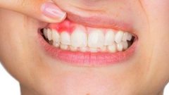 أسباب خُراج الأسنان أهمها تراكم البكتيريا على اللثة