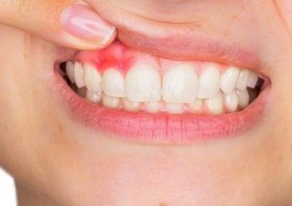 أسباب خُراج الأسنان أهمها تراكم البكتيريا على اللثة