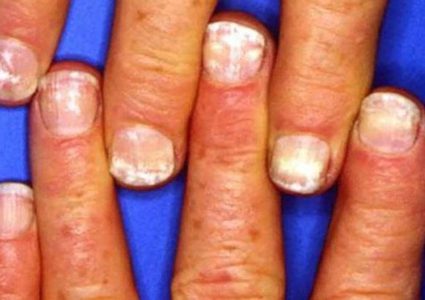 لماذا تظهر النقاط البيضاء على الأظافر؟