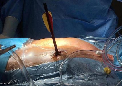 ذهب إلى المستشفى ماشيا بعد ان اصيب بسهم في قلبه !