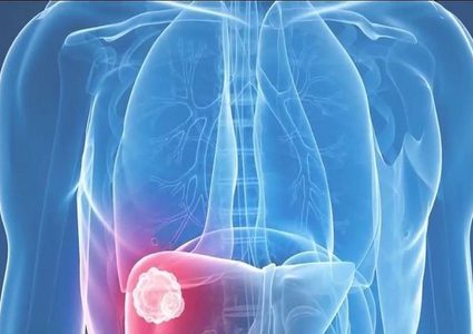 روسيا.. السماح باختبار دواء مضاد لسرطان المعدة