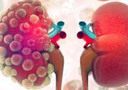 كيف يصوم مريض الكلى شهر رمضان ؟