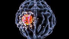 5 علامات تدل على إصابتك بورم في المخ