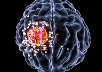 5 علامات تدل على إصابتك بورم في المخ