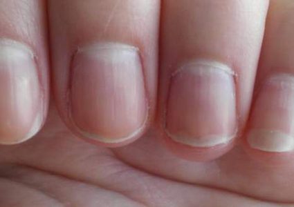 النساء أكثر عرضة لتشقق الأظافر من الرجال