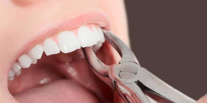 تعرفوا على خطوات وقف النزيف بعد خلع الضرس