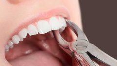 تعرفوا على خطوات وقف النزيف بعد خلع الضرس
