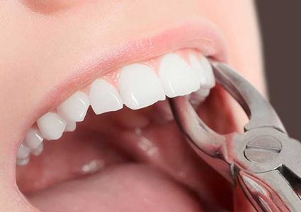 تعرفوا على خطوات وقف النزيف بعد خلع الضرس