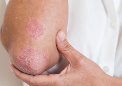 5 طرق تساعد علي منع انتشار الصدفية في الجسم