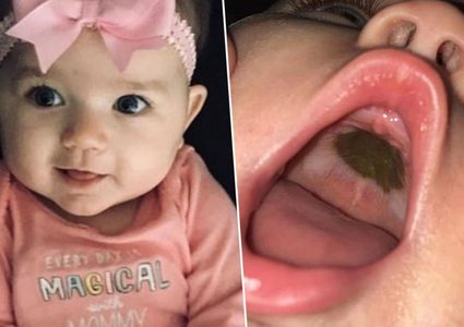 بقعة داخل فم رضيعة تثير ذعر والدتها.. والحقيقة صادمة