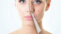 أطعمة تُساعدك على تجنب حب الشباب.. تناوليها يوميا!