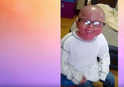 صبي يخلع جلده كالأفعى