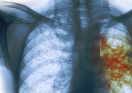 ما هو تأثير مرض السل على الرئة والدماغ ؟